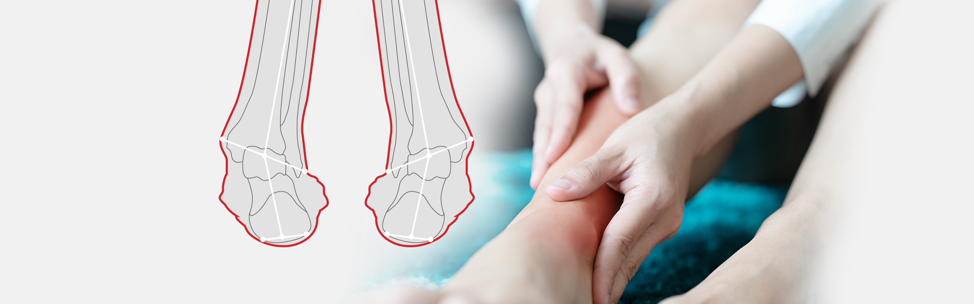 Supination Sole Solution