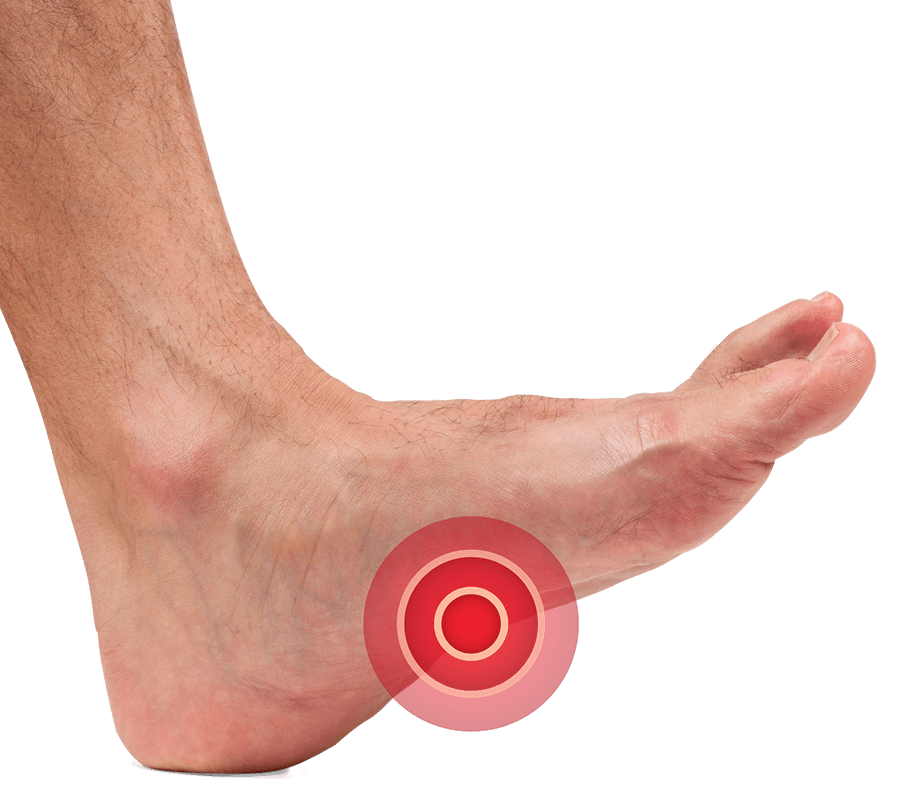 flat feet